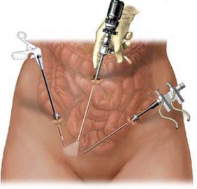 Laparoscopic Morcellation