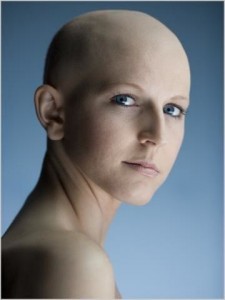 Chemo related permanent alopecia.