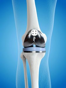 Depuy Knee Replacement